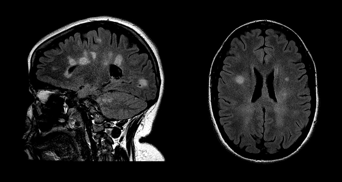 The Skid Marks MS Leaves on the Brain